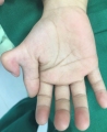PHẪU THUẬT CẮT TẬT THỪA NGÓN TAY TẠI BỆNH VIỆN ĐA KHOA HẠ LONG
