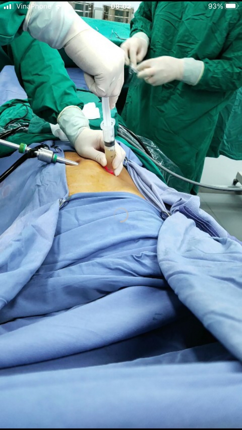 PHẪU THUẬT NỘI SOI THẤM MẬT PHÚC MẠC DO SỎI KẸT CỔ TÚI MẬT