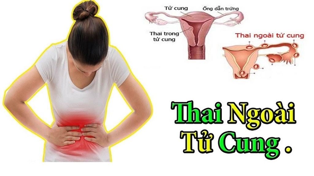 MỔ CẤP CỨU CA CHỬA NGOÀI TỬ CUNG PHẢI VỠ
