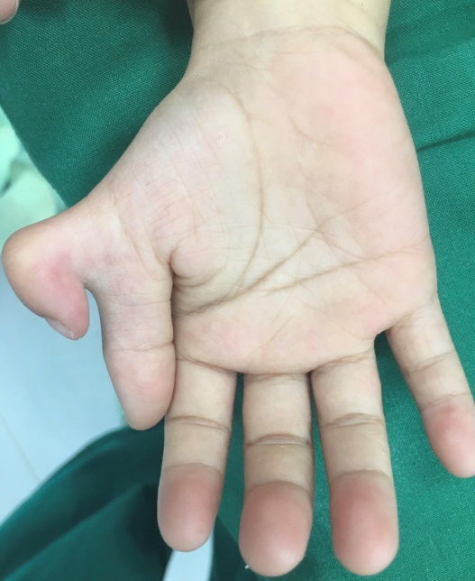 PHẪU THUẬT CẮT TẬT THỪA NGÓN TAY TẠI BỆNH VIỆN ĐA KHOA HẠ LONG